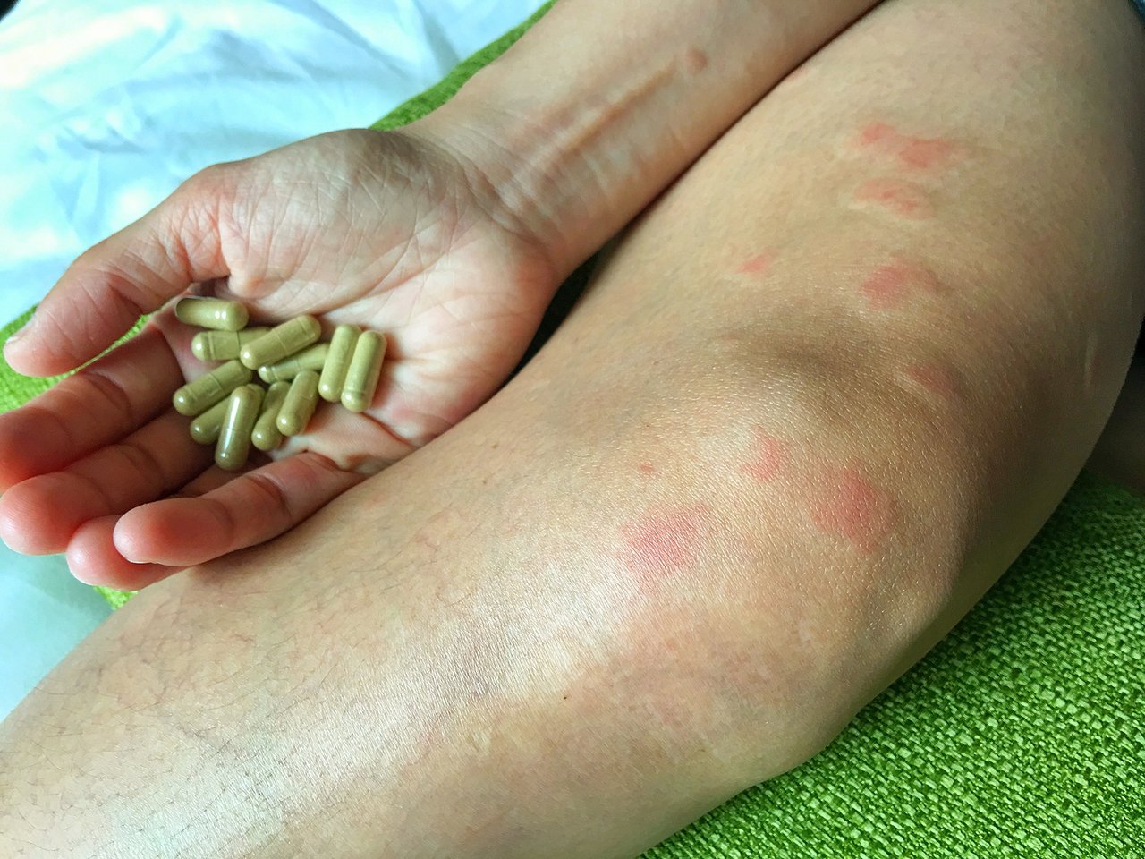 Lupus: ¿qué es, cómo se disgnostica y cúales son los síntomas?