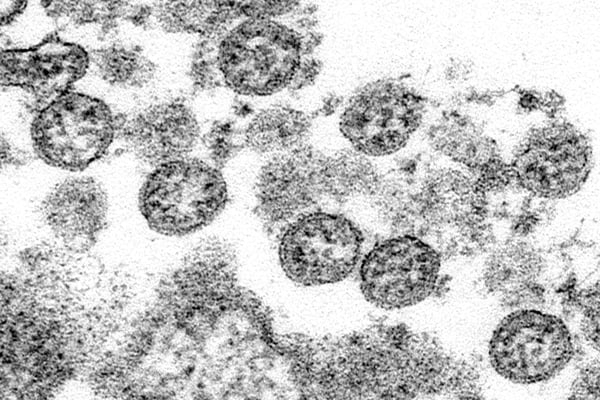 Autopsias revelan lo impactante que pasa con el cuerpo de los pacientes que murieron de coronavirus (FOTO)