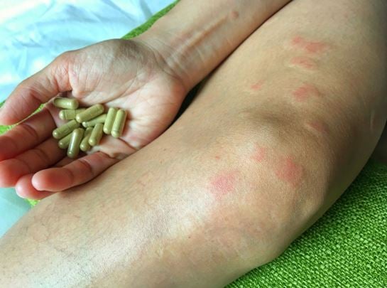 lupus what is it
