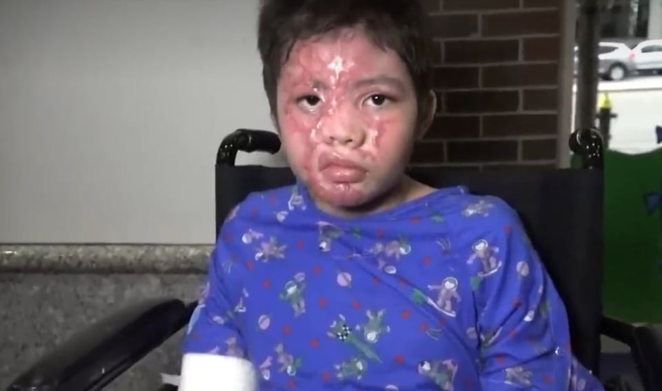 Alexander nos necesita. Niño hondureño quiere borrar las huellas que un incendio le dejó