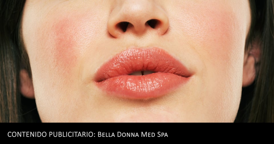 Por el mes de San Valentín aprovecha los descuentos en rellenos de labios. $50 off