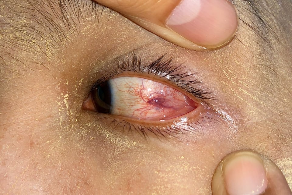 Curioso: Le sacaron 20 gusanos vivos de su ojo (VIDEO)