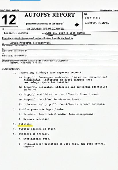 Autopsy Michael Jackson: An accident left him without hair