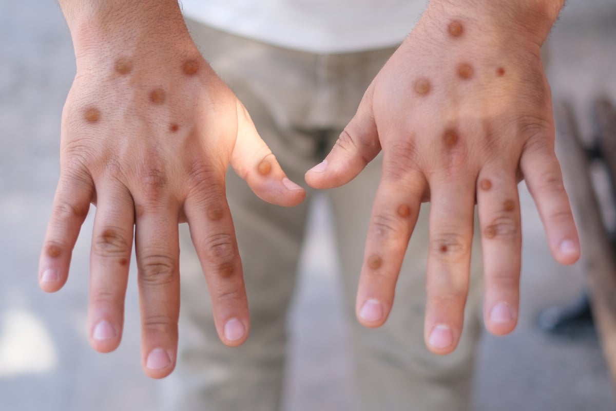 World Health Organization gives unexpected news of mpox