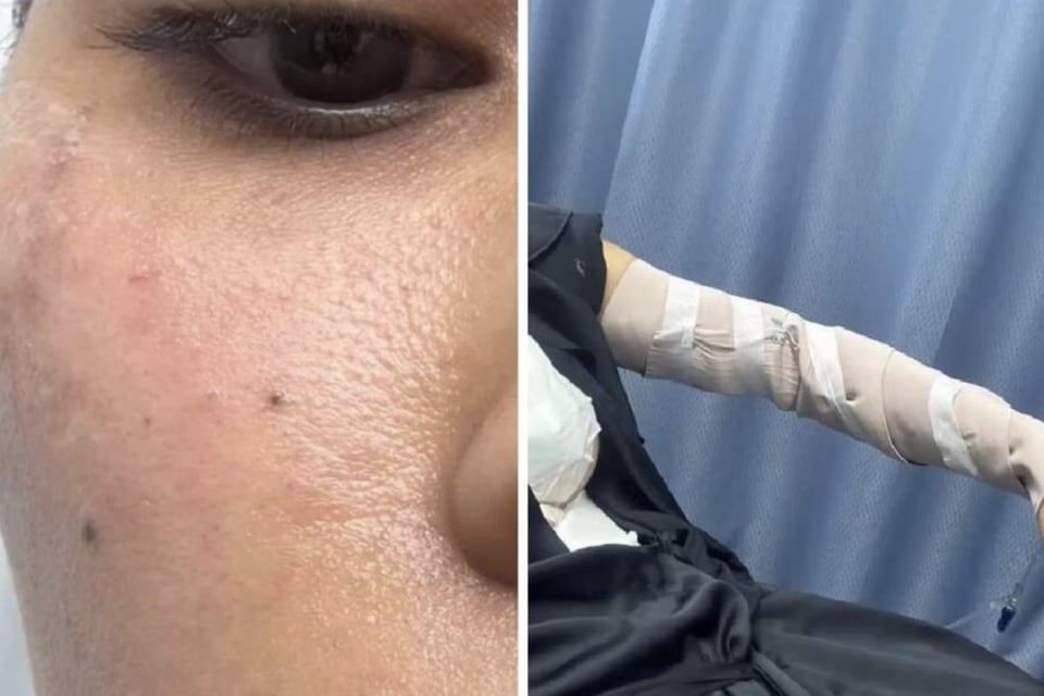 Exreina de Belleza Sufre Quemaduras Tras Explosión de una Olla featured image