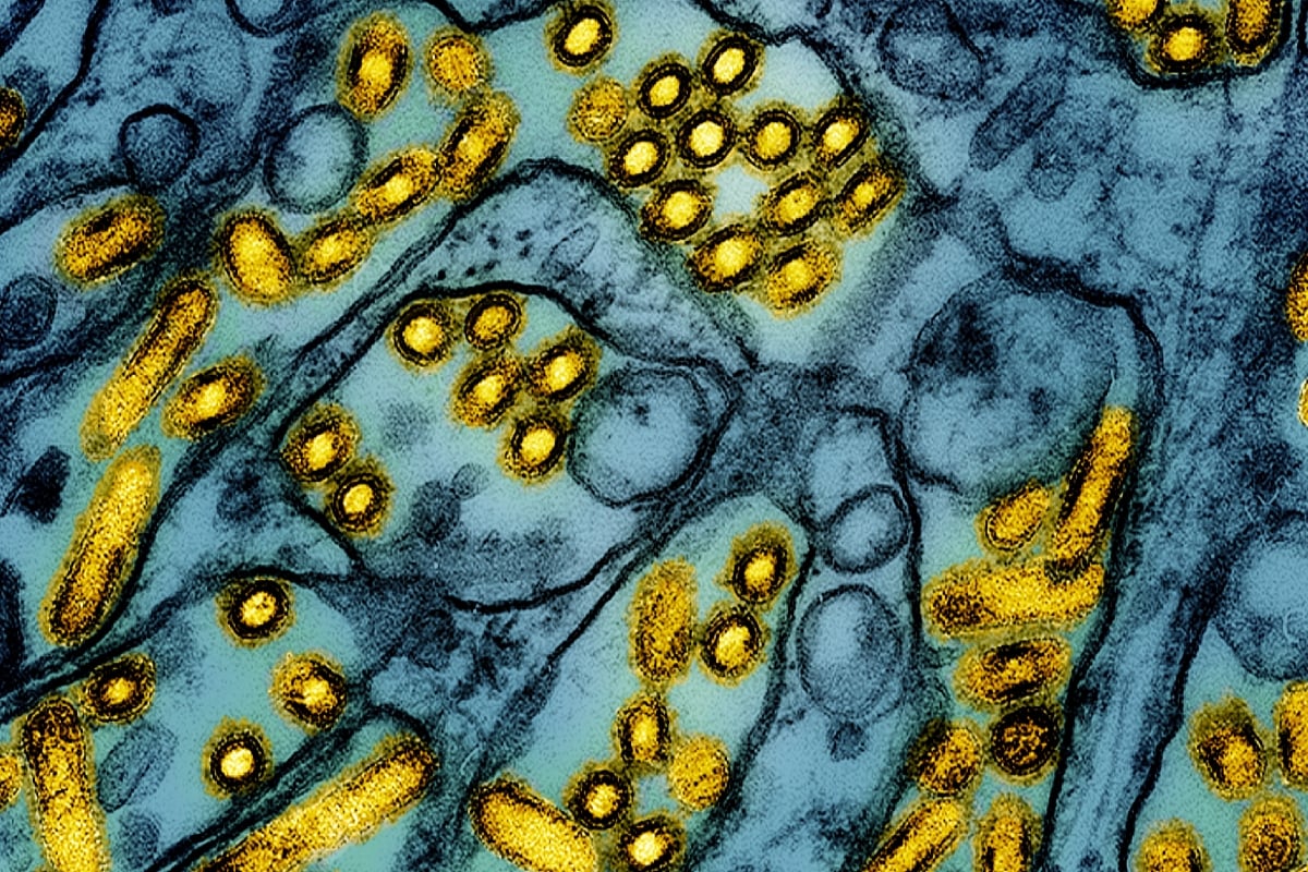gripe aviar en EEUU, paciente, hospital, primer caso, First Severe Case of H5N1 Bird Flu, patient, hospital, first case, MundoNOW