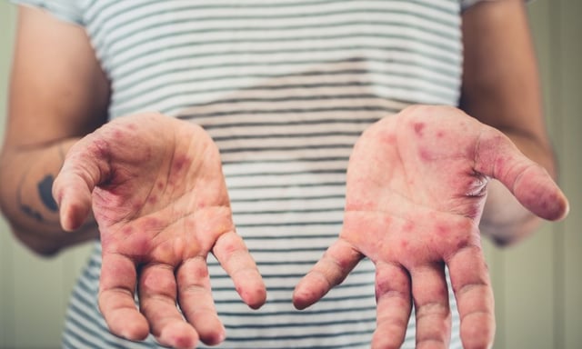 Measles Alert in New York: Vaccination Recommendations for Travelers Amid Active Outbreak