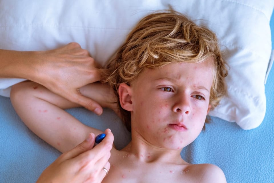 fiebre, manos, ampollas, virus, medicina 