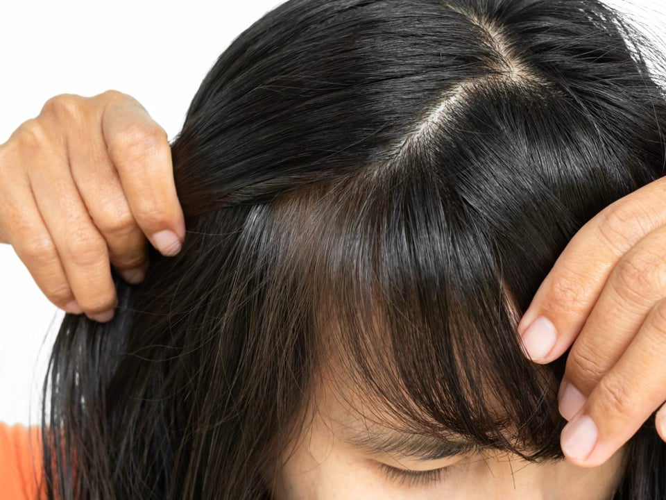 caspa en el cabello