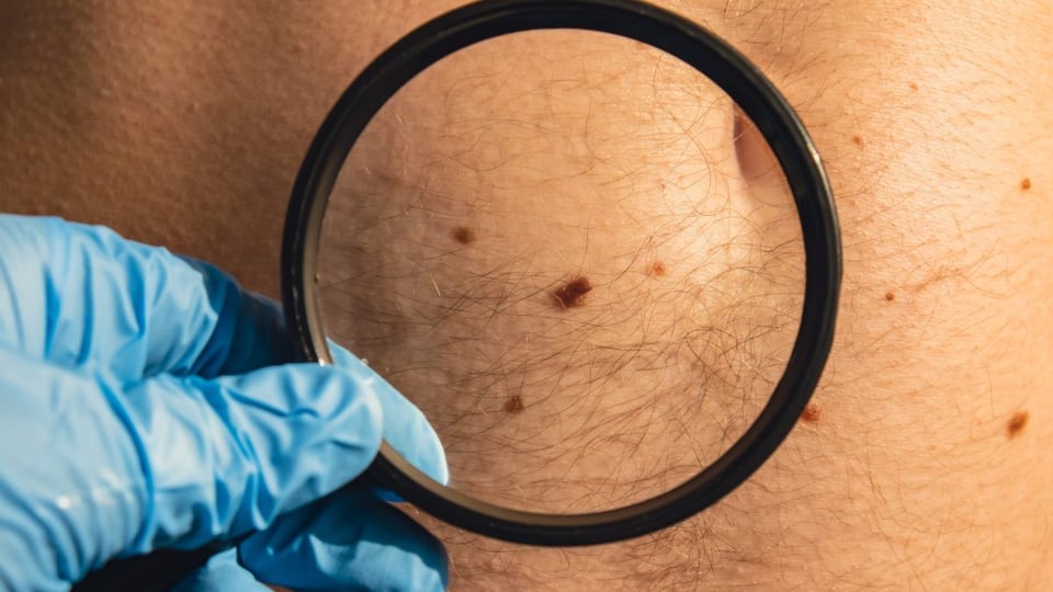 ¿Sabes qué tipo de lunares tienes? Los dermatólogos lo explican