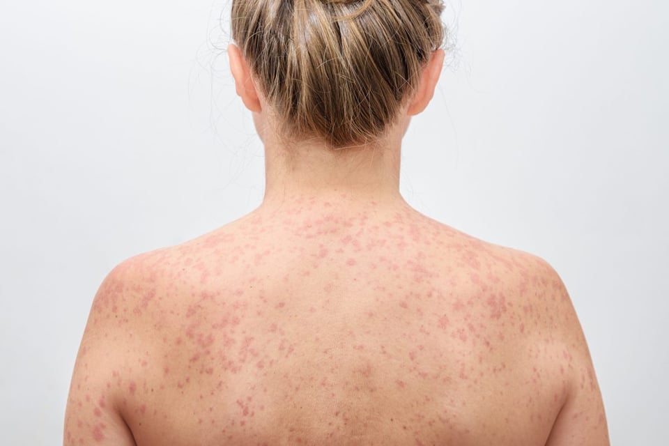 sarampión,, piel, sintomas, enfermedad, virus 
