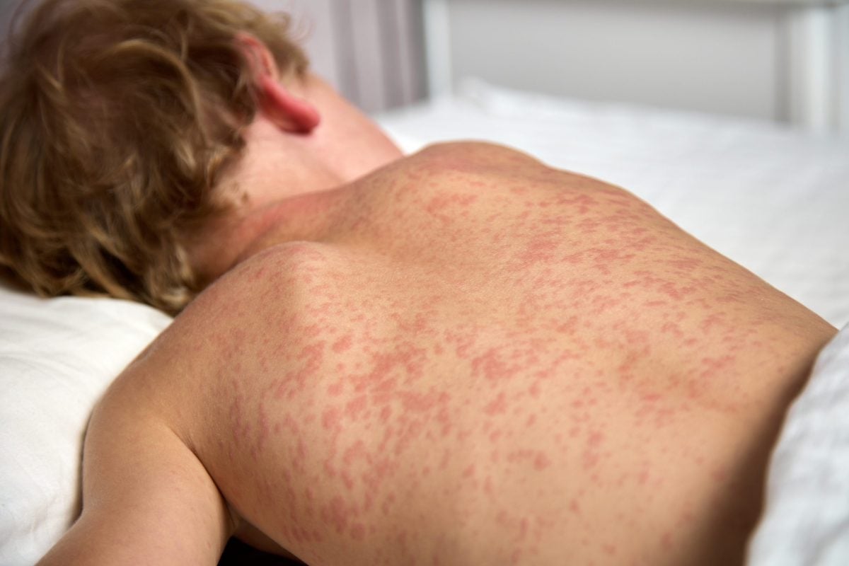Nuevo brote de sarampión en Estados Unidos: ¡Descubre cómo proteger a tu familia ahora!