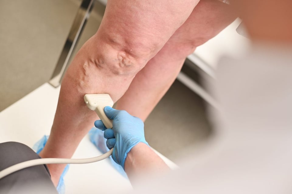 Tus piernas hablan: lo que las Várices pueden advertirte sobre tu salud
