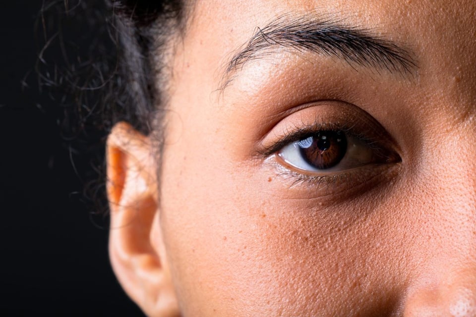 OJERAS, TRATAMIENTO, REMEDIOS, BLANCAS, NEGRAS 