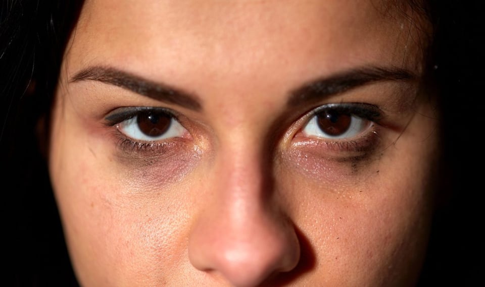 ojeras, ojos, belleza, tratamiento 