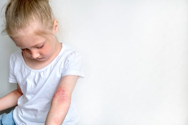 Eccema Atópico: cómo vivir con esta condición sin perder calidad de vida!