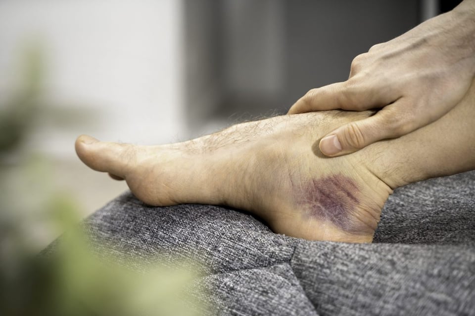 bruises, doctor, skin, blood, colors, Easy Bruising? Learn the Causes and When to Worry