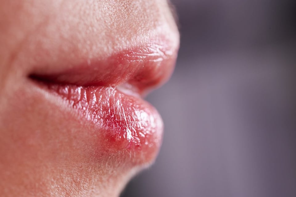 labios agrietados , frio, dolor, sequedad 