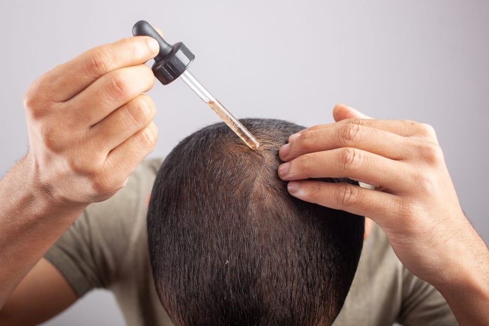minoxidil , cabello, caida, mitos, verdades