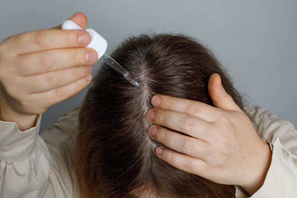 Minoxidil: Todo lo que realmente debes saber antes de usarlo!