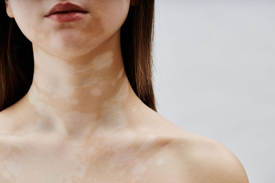 Todo sobre el Vitiligo: causas, síntomas y tratamientos disponibles! featured image