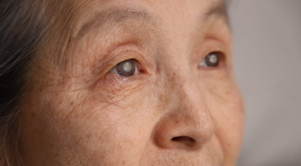 cataratas, ojos, cirugia, vista, oftamologo, Cataracts and Vision Loss: Everything You Need to Know