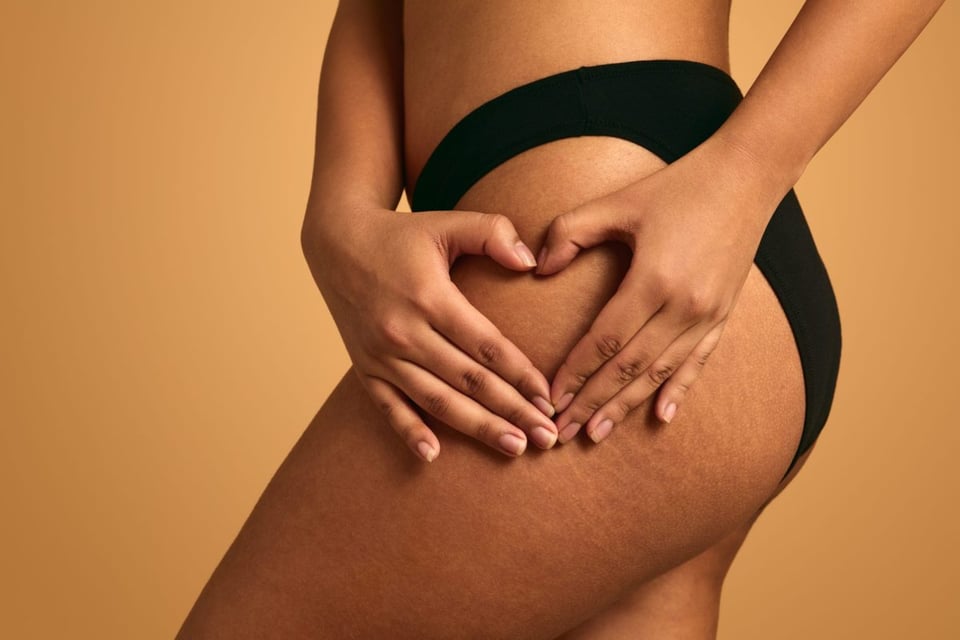 5 trucos reales para disimular las estrías y mejorar el aspecto de la piel