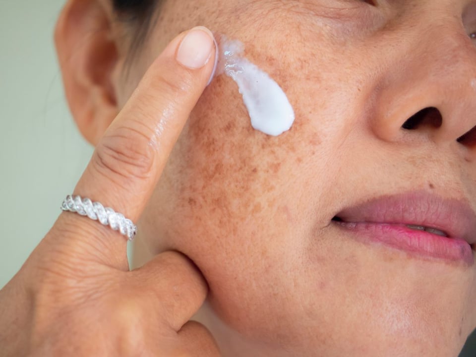 piel, melasma, hiperpigmentacion, manchas, oscuras, Melasma or Hyperpigmentation? Learn to Tell the Difference