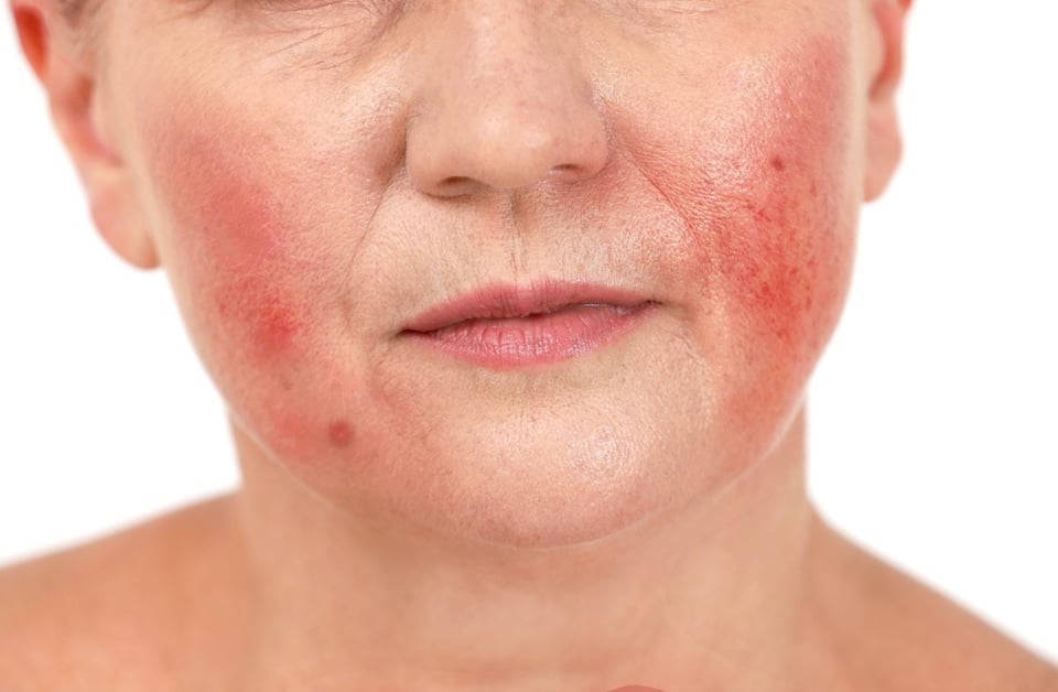 rosacea, piel, enfermedad, soluciones, roja 