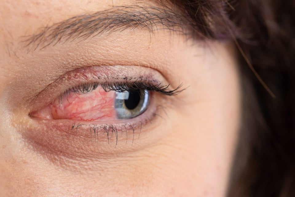 rosacea, ocular, piel, roja, enrojecimiento 