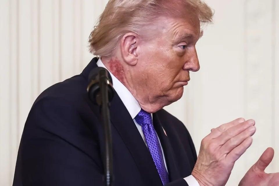 Marca visible en el cuello de Trump desata preguntas sobre su salud