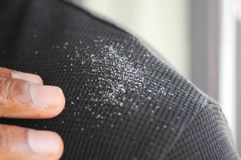 caspa, cabello, problema, 5, consejos, productos, how to prevent dandruff