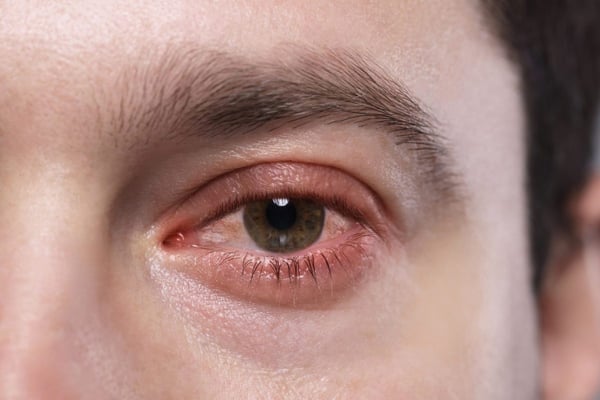 ¿Ojos rojos, pegados o con picazón? Podrías tener uno de los 3 tipos de conjuntivitis