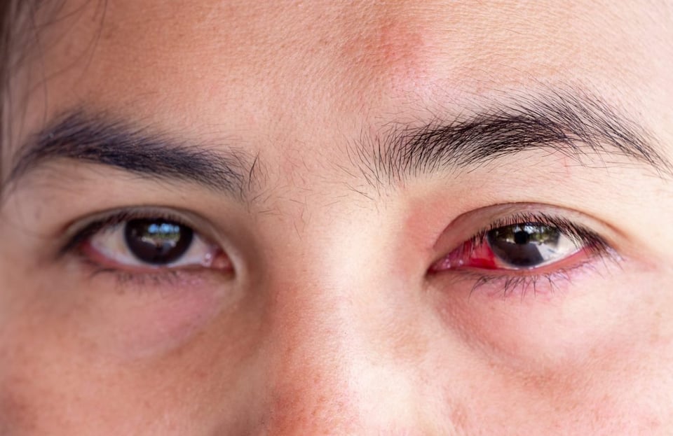 ojos, conjuntivitis, ojo rosado, infeccion, viral, alergia 