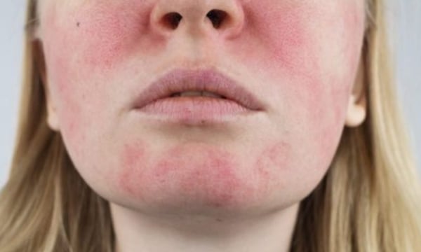 Abril es el mes de la rosácea: la señal en tu piel que muchos ignoran y cómo controlarla a tiempo