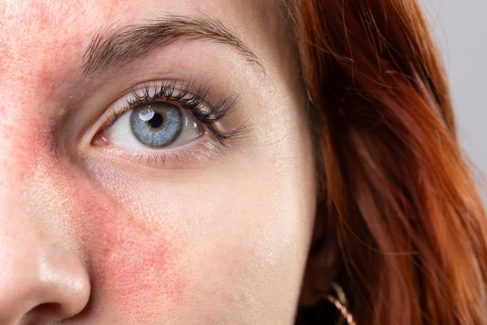 rosacea, afeccion, piel, cremas, tratamiento, medicos