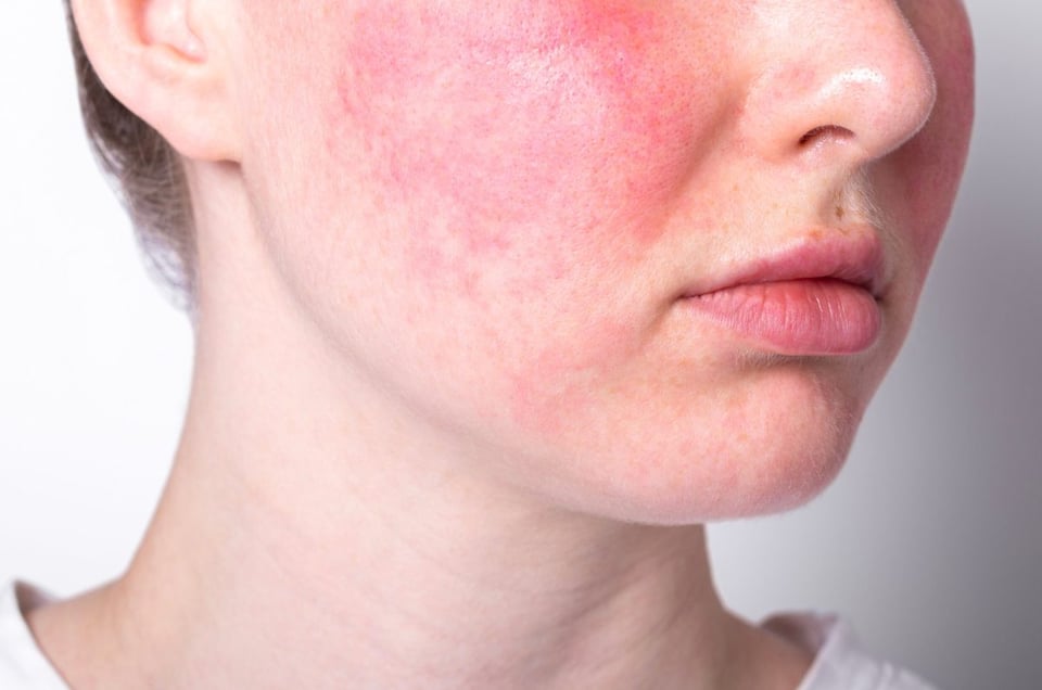 rosacea, piel, tratamiento, adecuado, mes, rosacea