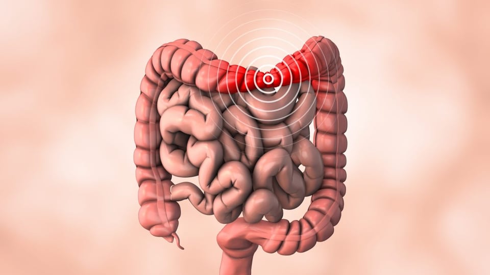 colon, irritable, dolor, gases, salud, sintomas, comunes 