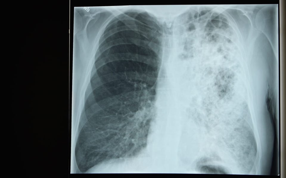 legionela, legionelosis, enfermedad, virus, pulmonar, agua, nueva, york, cdc 