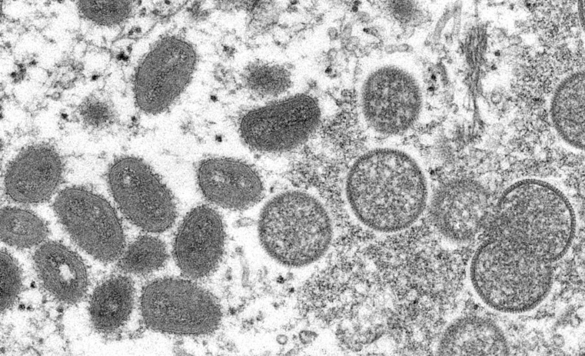 Confirman más de 70 casos de viruela del mono en EEUU y convocan a Comité de Emergencia