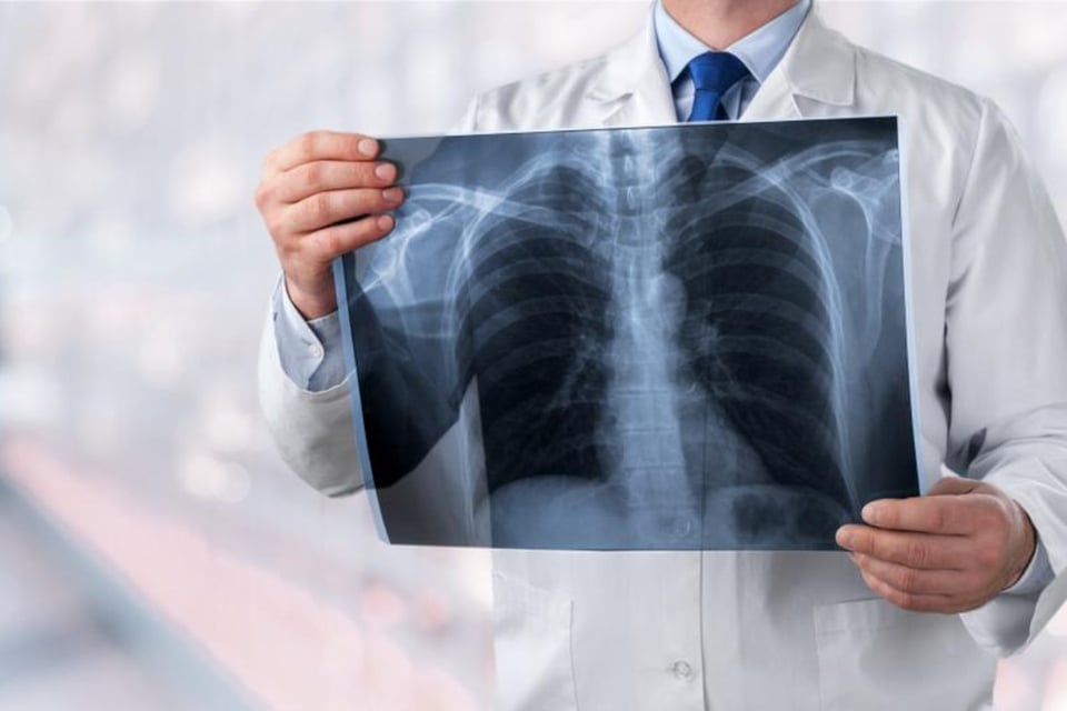Mexicano supera el cáncer de pulmón