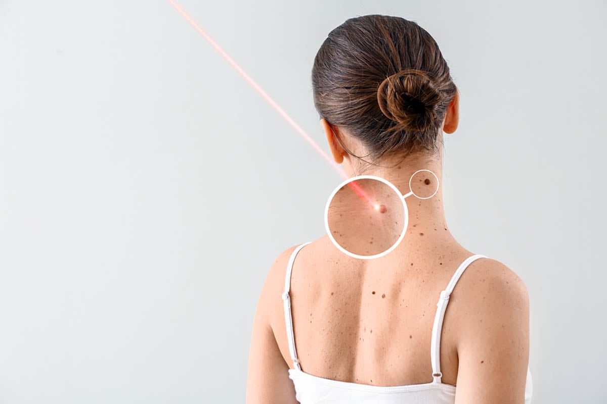 Home remedies for warts: What really works