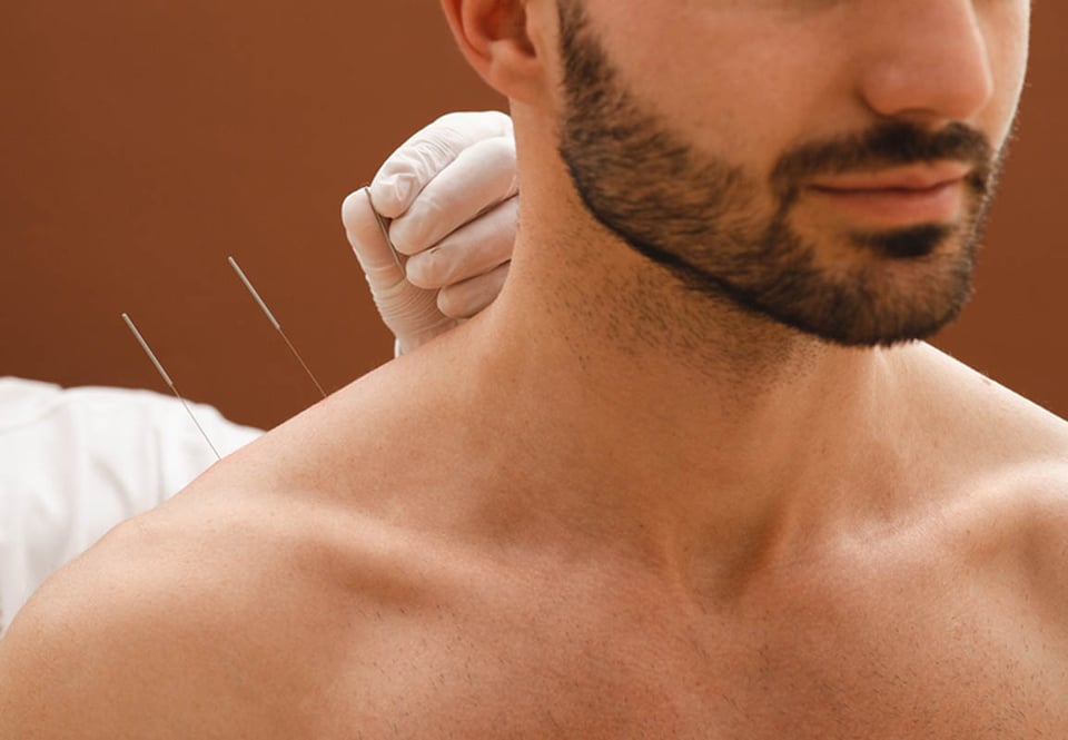 Agujas, acupuntura, hombro, medicina natural, MundoNOW