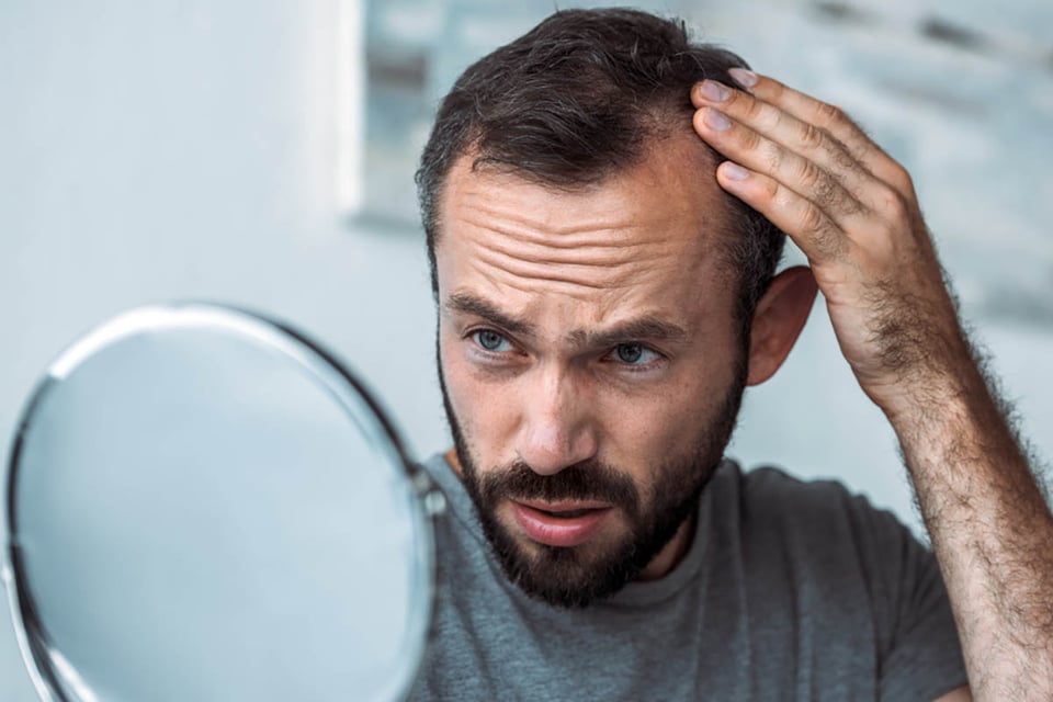 Comprender la calvicie de patrón masculino y soluciones modernas