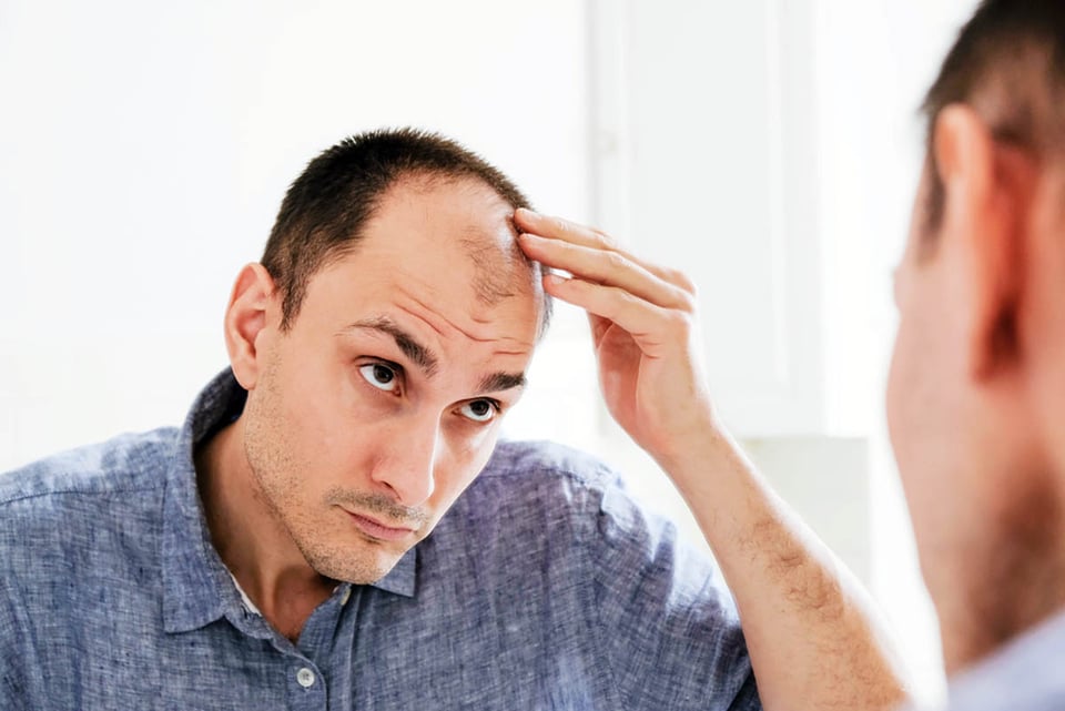 Masculino, patrón de caída del cabello, calvicie, tratamiento, soluciones.