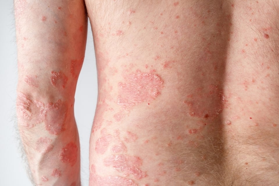 gastric sleeve, psoriasis, social networks