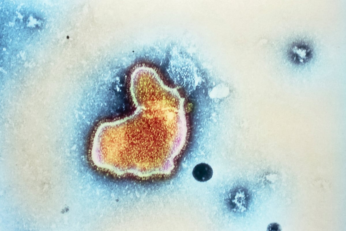 Muere niño en EEUU por virus respiratorio sincitial mejor conocido como RSV