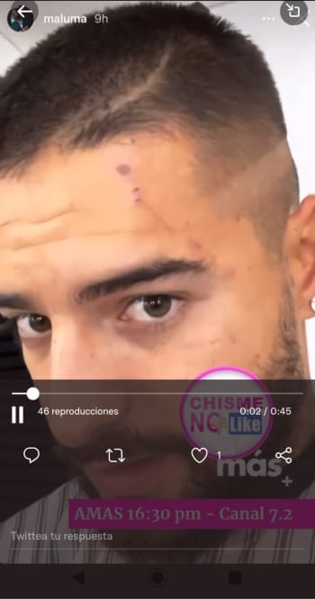 Maluma shows doberman wounds