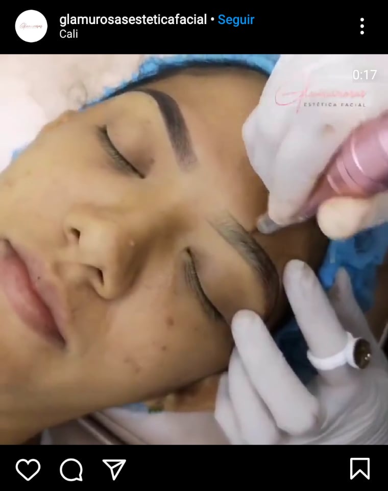 Eliminar pelos encarnados cejas