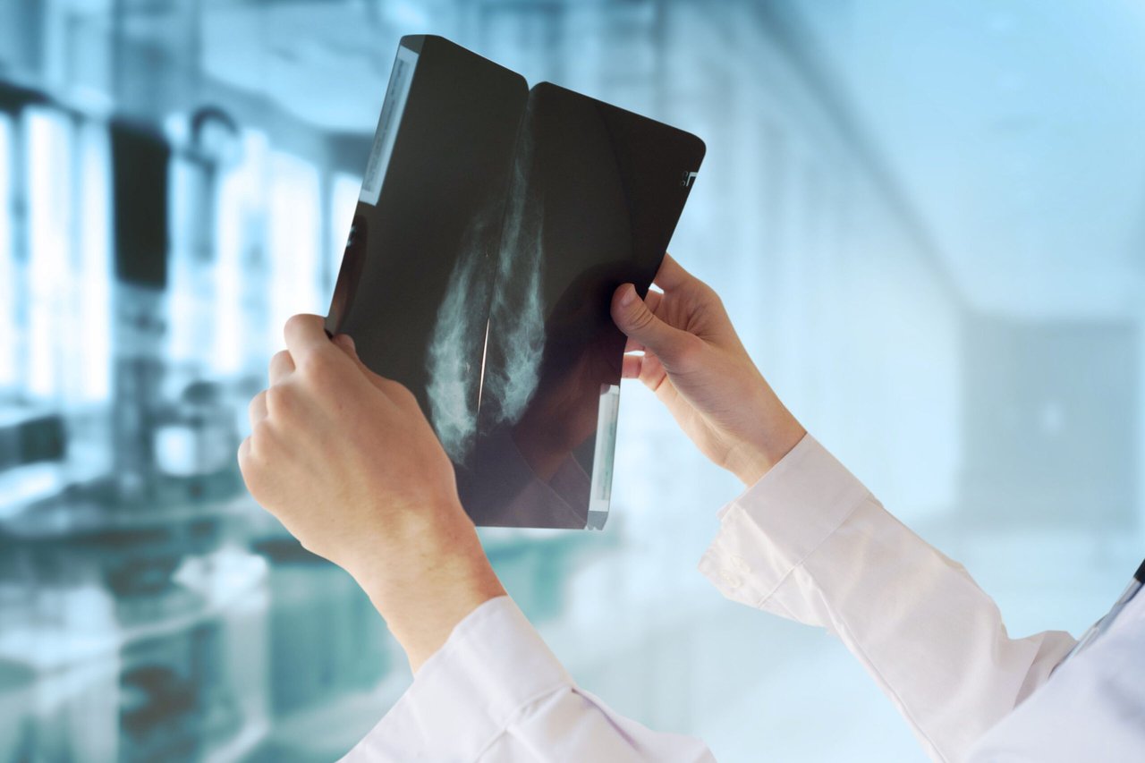 Breast of the Breast: 30 Facts about Breast Cancer We All Should Know and Share Part 2